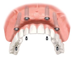 Implantologia All on four 1 Studio Dentistico Smart Dental Tivoli Campolimpido