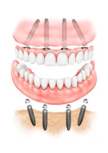 Implantologia All on four 3 Studio Dentistico Smart Dental Tivoli Campolimpido